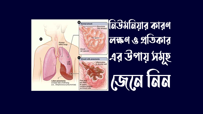 নিউমনিয়ার কারণ-লক্ষণ ও প্রতিকার