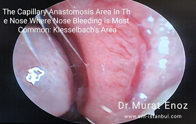 The Capillary Anastomosis Area In The Nose Where Nose Bleeding is Most Common: Kiesselbach's Area