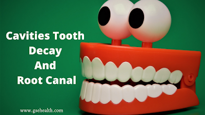 Cavities Tooth Decay And Root Canal