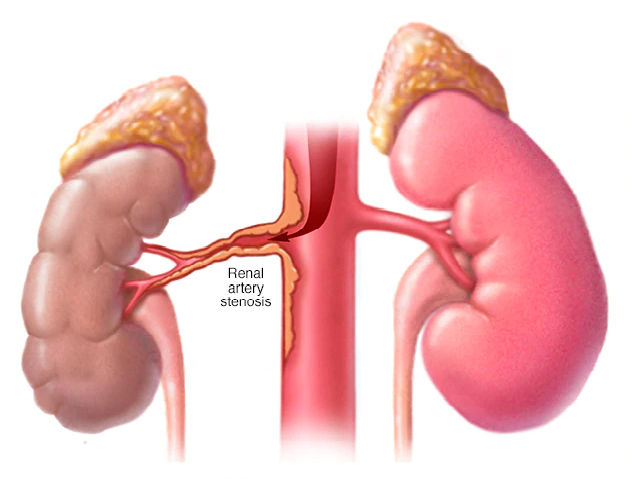 Renovascular Hypertension (RVH) part 3: Clinical presentation and differential diagnosis 