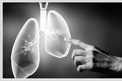 Popular Procedures for Lung Cancer Treatment