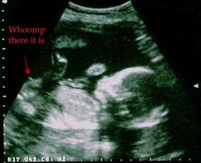 3d ultrasound pictures at 20 weeks. We are proud to announce that