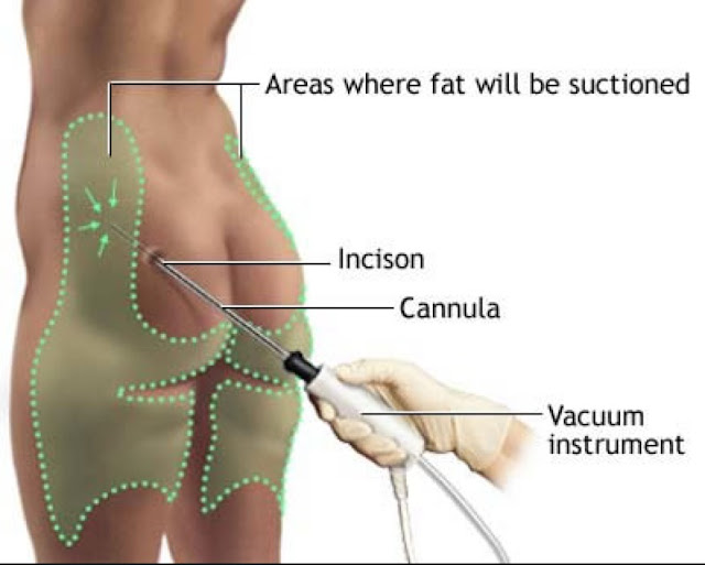 Areas where fat will be suction liposuction surgery