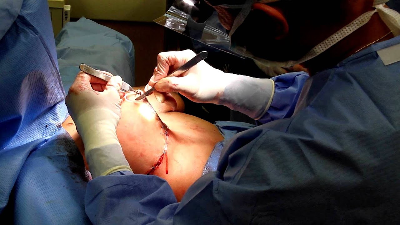How Much Does A Breast Lift Cost