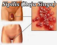 Berapa Harga Obat Sipilis De Nature Yang Benar