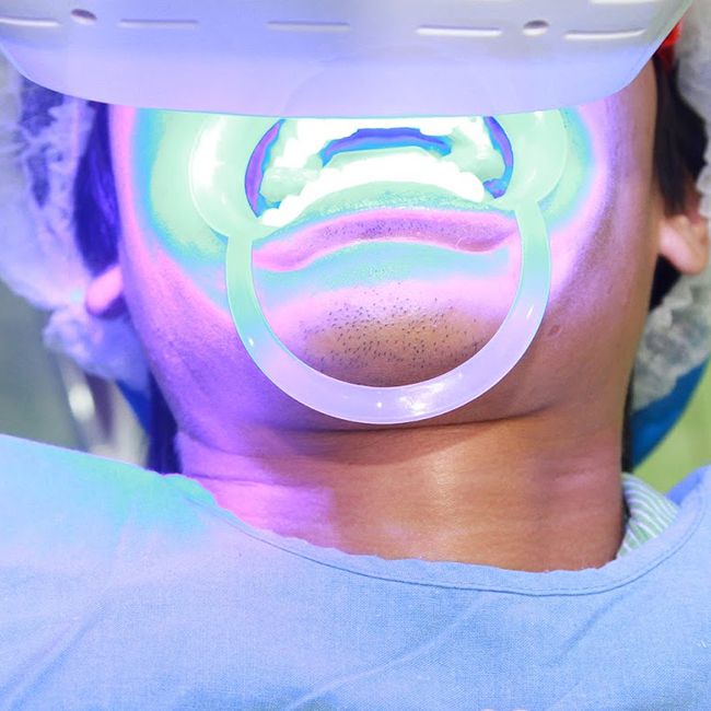 Tẩy trắng răng bằng laser whitening có nguy hiểm không?
