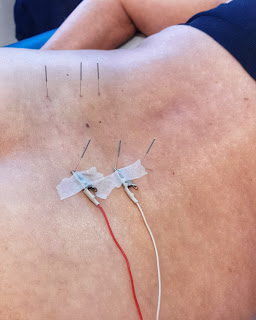 6 agulhas de acupuntura na região lombar
