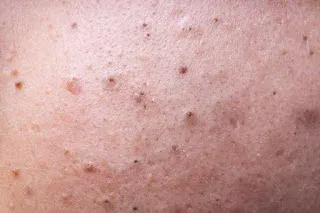 Do You Know What Kind Of Pimples You Have?