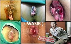 obat wasir