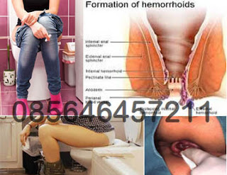 Obat Wasir (Hemoroid) Parah Paket 1 Bulan
