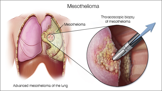 Mesothelioma