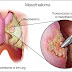 Mesothelioma