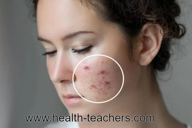 Important measures and prescriptions for prevention of rash diseases - Health-Teachers