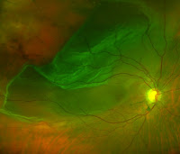 retina detachment surgery