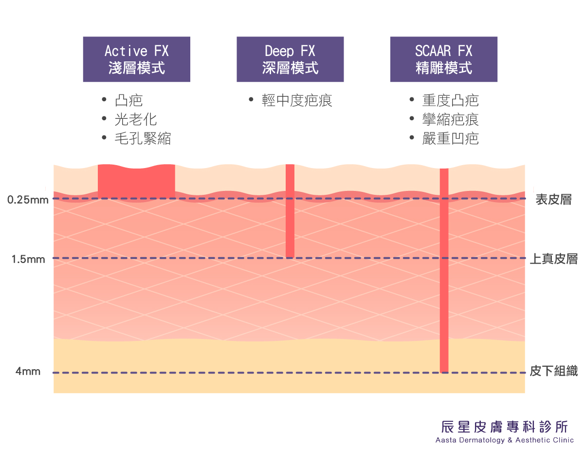 UP雷射示意圖-內湖辰星皮膚專科楊兆傑醫師