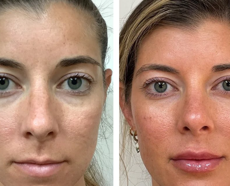 40 Units of Botox before And After: Stunning Transformations