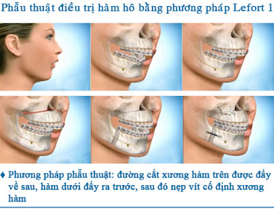 Phẫu thuật cắt xương hàm có nguy hiểm không?