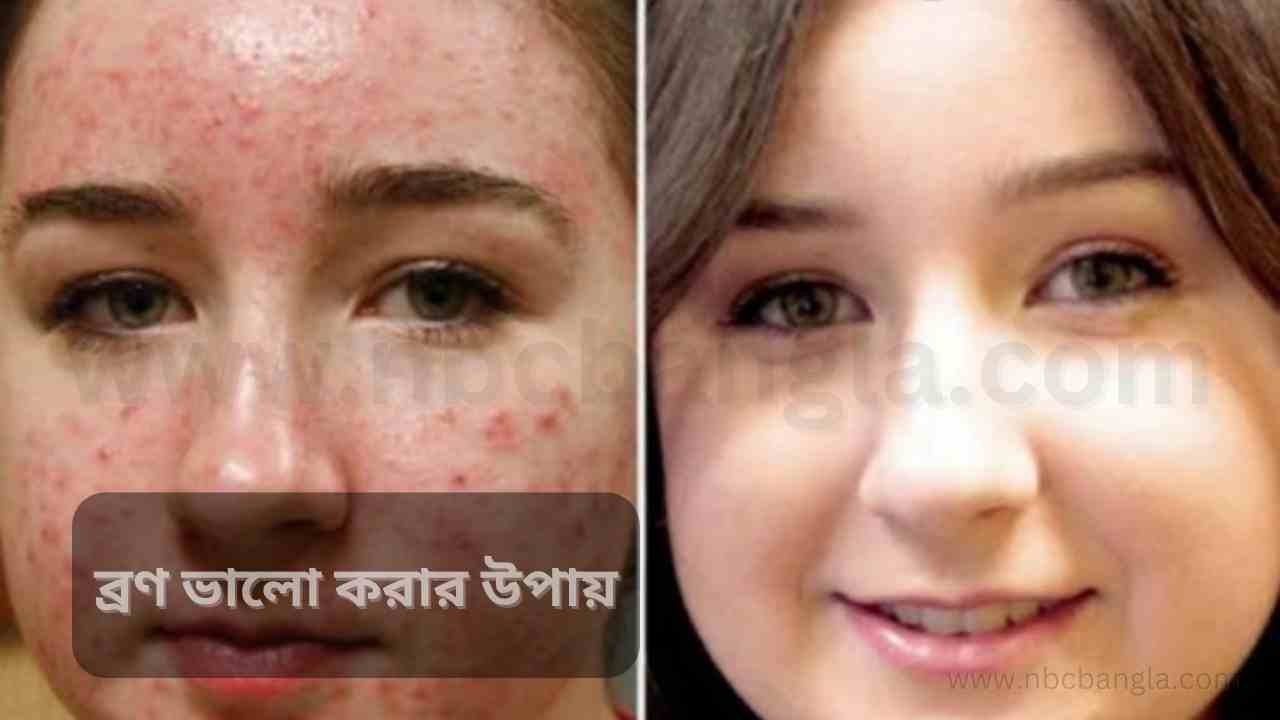 How to get rid of acne, how to get rid of face acne, how to get rid of acne scars, easy way to get rid of acne, how to get rid of acne on face for boys, acne removal cream, how to get rid of acne scars, acne, how to get rid of acne in one night, Ways to get rid of acne fast, ways to get rid of acne, ways to get rid of acne scars fast, easy ways to get rid of acne scars, easy ways to get rid of acne, what is the way to get rid of acne, home remedies to get rid of acne, remove acne and dark spots on face way to do