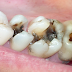 Sâu răng chỉ còn chân răng nên làm gì?