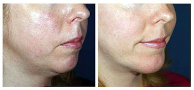 Chin Surgery Before And After