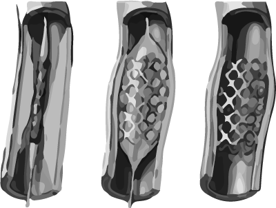 Coronary stent