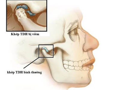 Viêm khớp thái dương hàm là gì