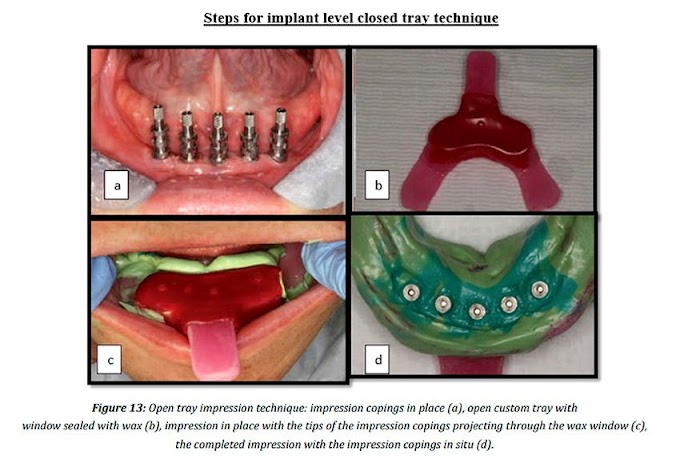 PDF: A Comprehensive Review of Basic Implant Impression Techniques