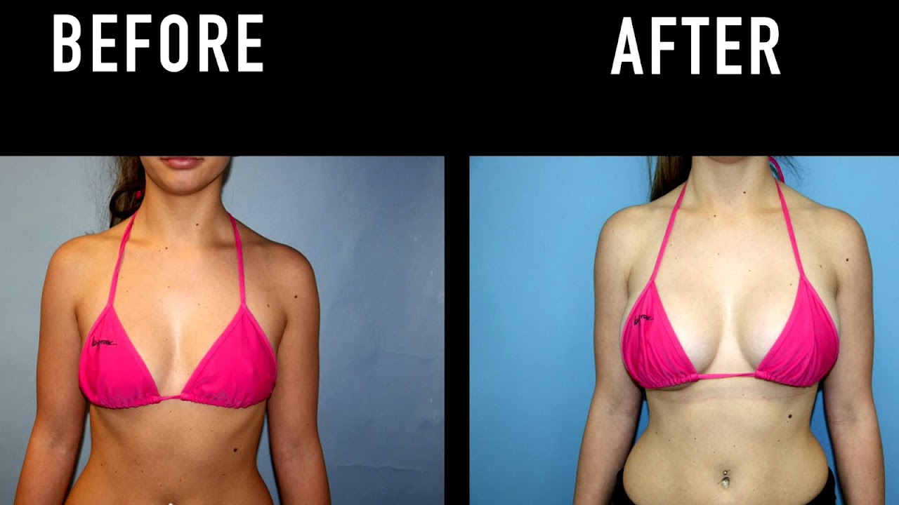 Breast Lift Miami