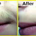 Permanent hair removal technique at home for facial hair