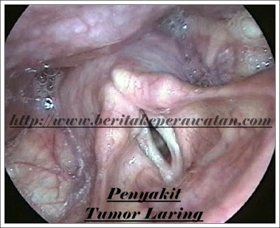 Kenali Penyebab Seseorang Mengalami Tumor Laring Pada Tenggorokan