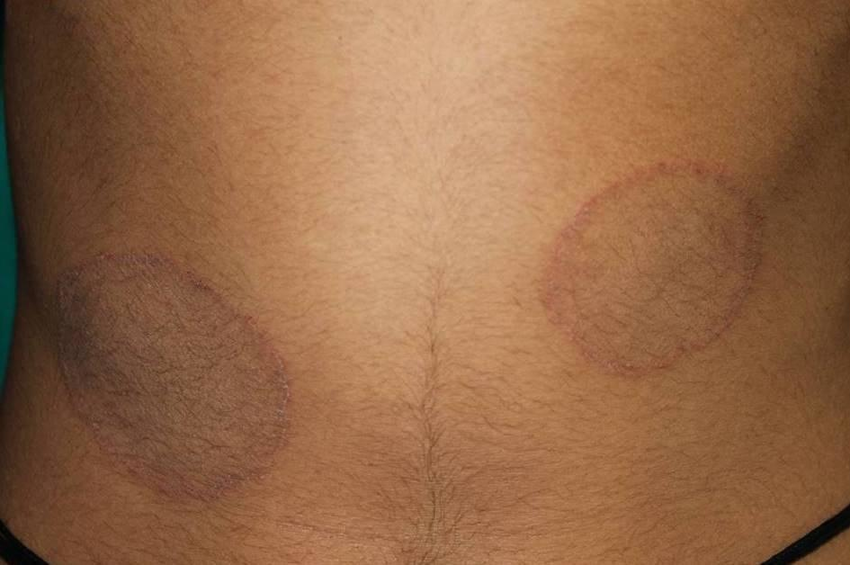 Blog Dr. Carlos: Micoses de pele / tinea corporis / ringworm