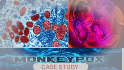 Monkey pox case definition