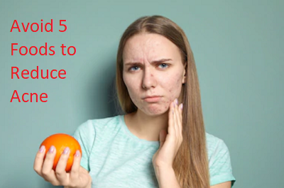 Avoid 5 Foods to Reduce Your Acne Problem