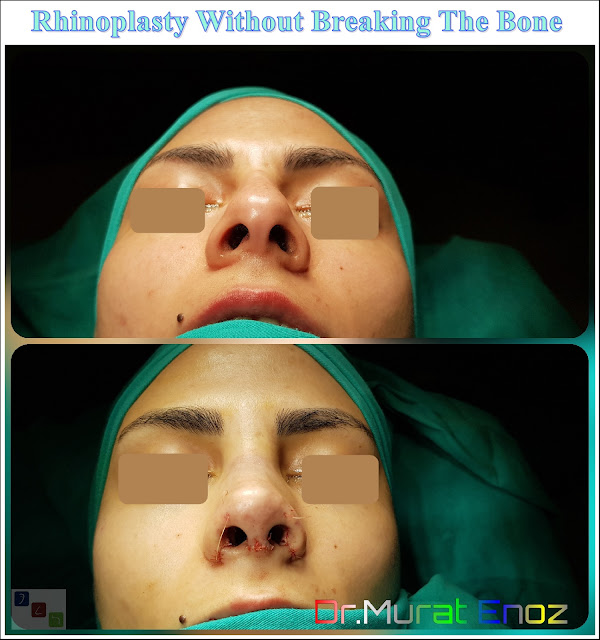 Rhinoplasty Operation Without Breaking The Nasal Bone