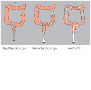 How ulcerative colitis is diagnosed 