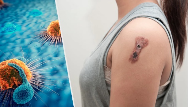Todo lo que debes saber sobre el cáncer de piel