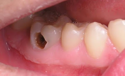 Răng cấm bị sâu có nên giữ lại không?