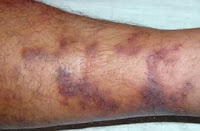 kaposi's sarcoma pictures