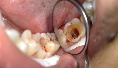 Bọc răng sứ cho răng hàm bị sâu
