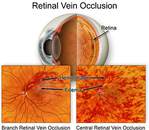 Retinal Artery Occlusion