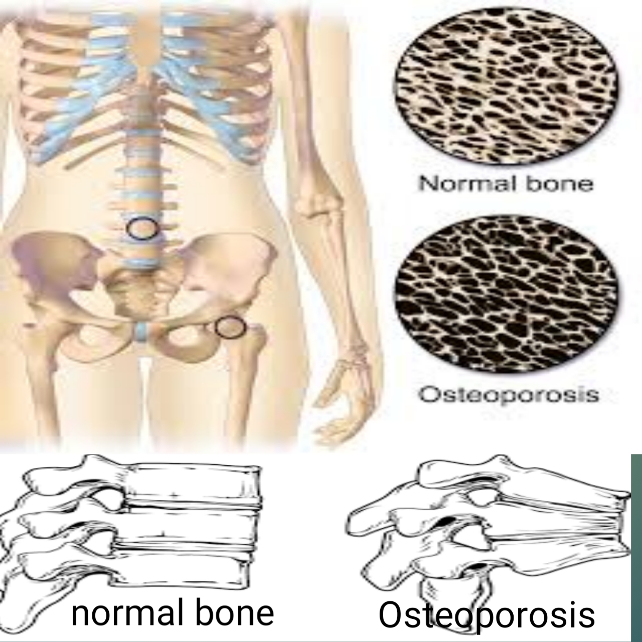 Osteoporosis Treatment, Osteoporosis - Treatment