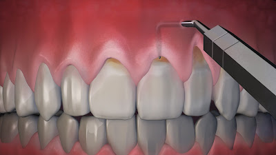 Gum Recession Treatment