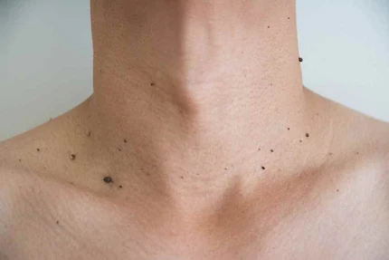 2 Most Powerful Natural Home Remedies For Moles on Skin