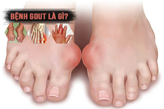 Bệnh Gout là gì