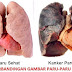 Cara Mengatasi Penyakit KANKER PARU-PARU