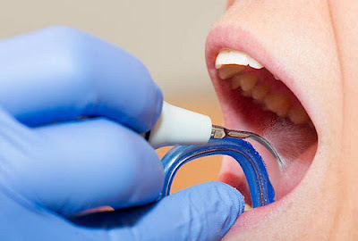 Điểm danh các phương pháp trị bệnh ê buốt răng 2