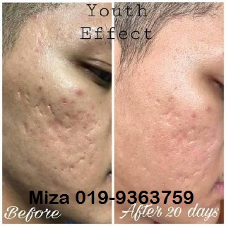 Testimoni Youth Skincare untuk parut berlubang lelaki