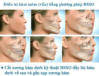 Phẫu thuật chỉnh xương hàm chữa móm bằng kỹ thuật BSSO