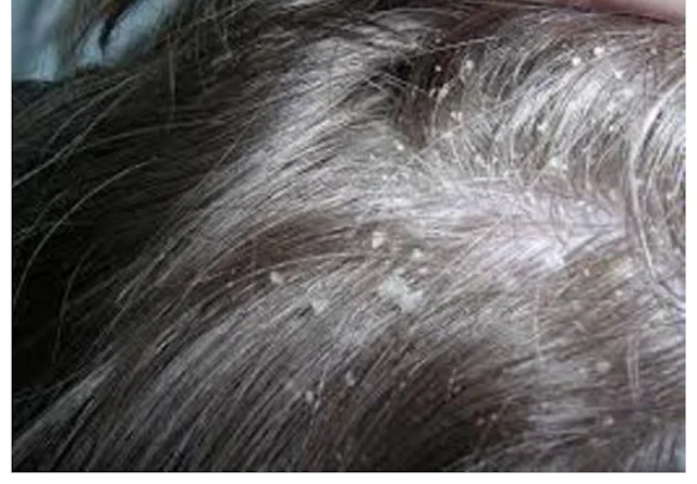 Here are 7 home remedies to get rid of hair follicles