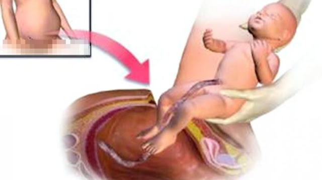 Jangan Terburu-buru Memilih Operasi Caesar, Ini Cara "Membujuk" Janin Agar Lahir Normal...!!!